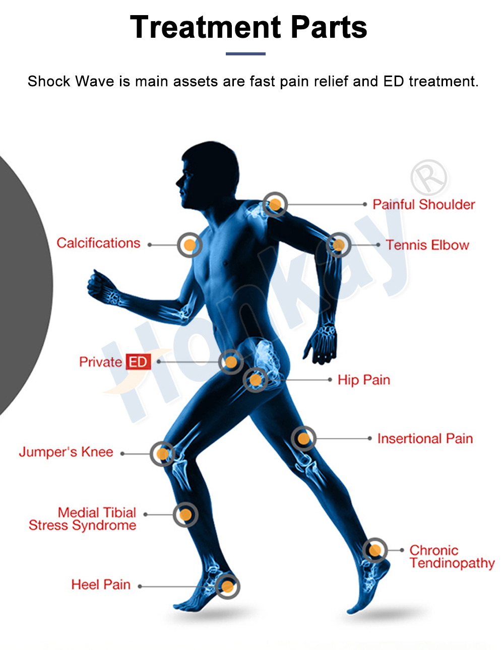 Treatment parts for shockwave therapy shown on a body map with labelled points including painful shoulder, tennis elbow, calcifications, insertional pain, jumper's knee, hip pain, heel pain, medial tibial stress syndrome, chronic tendinopathy and the private ED indication